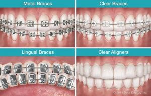 Braces - Dento-Facial Health - San Diego Dentist