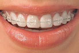 Braces - Dento-Facial Health - San Diego Dentist